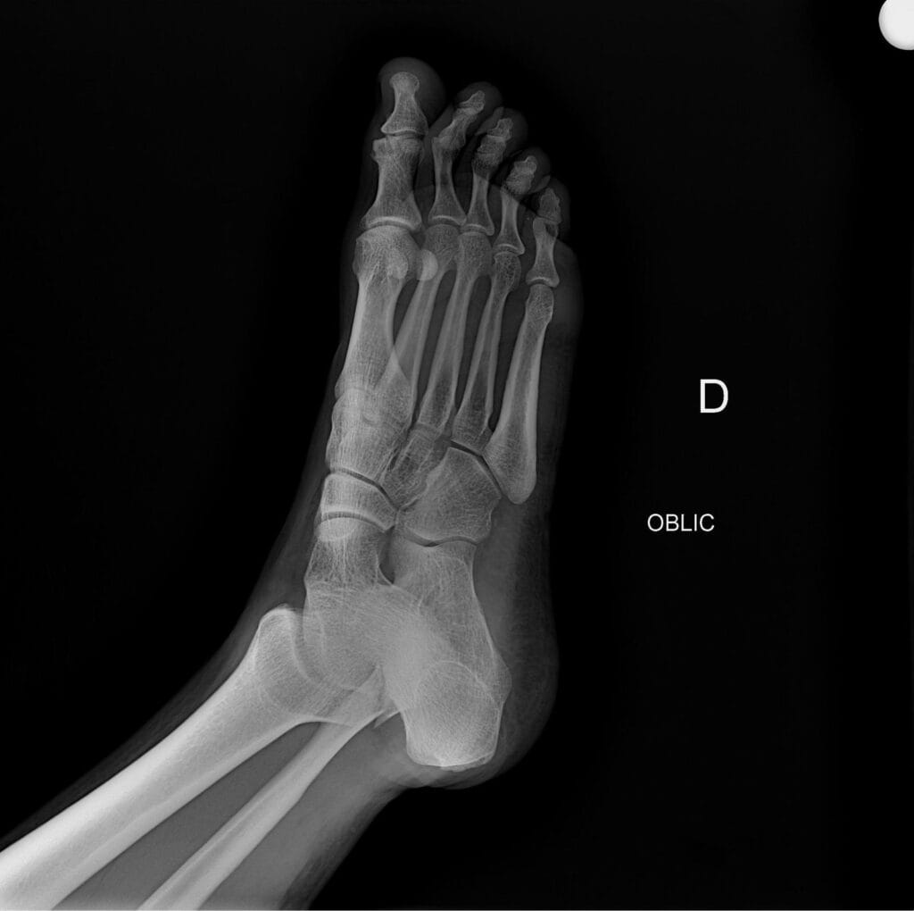 Radiografia fractura perone